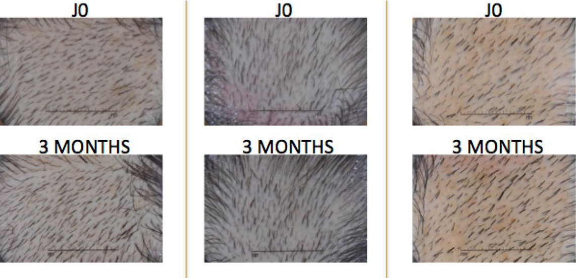 リデンシルを用いて薄毛が改善した被験者の頭頂部の画像